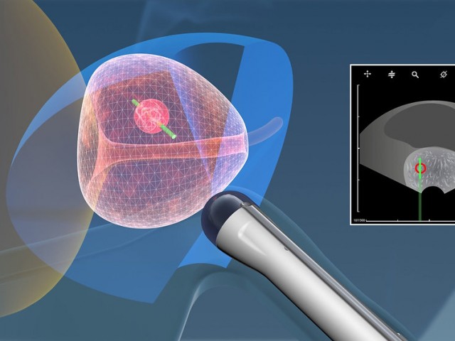 Биопсия предстательной железы